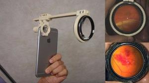Oftalmoscopio Para Smartphone, Elaborado Por Impresión 3d