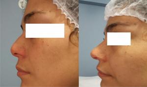 RINOMODELACION perfilacion de nariz sin cirugia