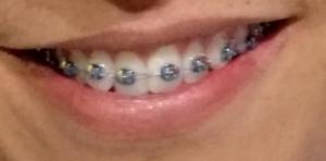 en Venta Brackets Safiro Gold